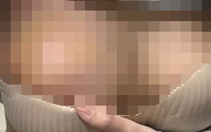 Biến chứng từ tiêm filler ngực. Ảnh: Lao Động.