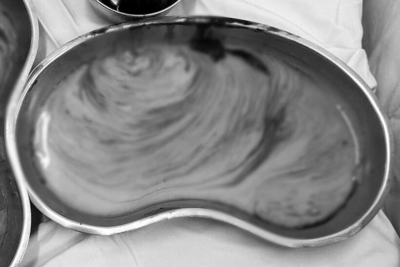 Lượng dịch khổng lồ được lấy ra khỏi vòng 3 của người phụ nữ. Ảnh: Dân Trí.