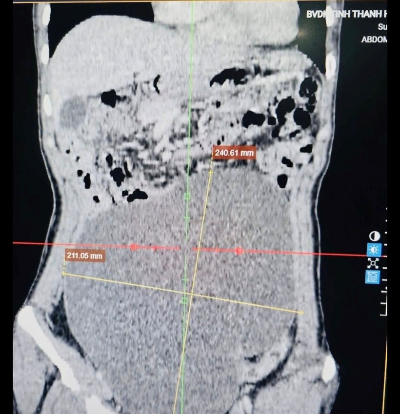 Hình ảnh khối u trong cơ thể nữ. Ảnh: Báo Công lý.