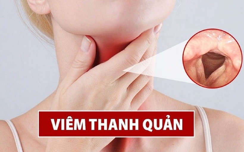 Viêm thanh quản là bệnh thường gặp ở người “nói nhiều”