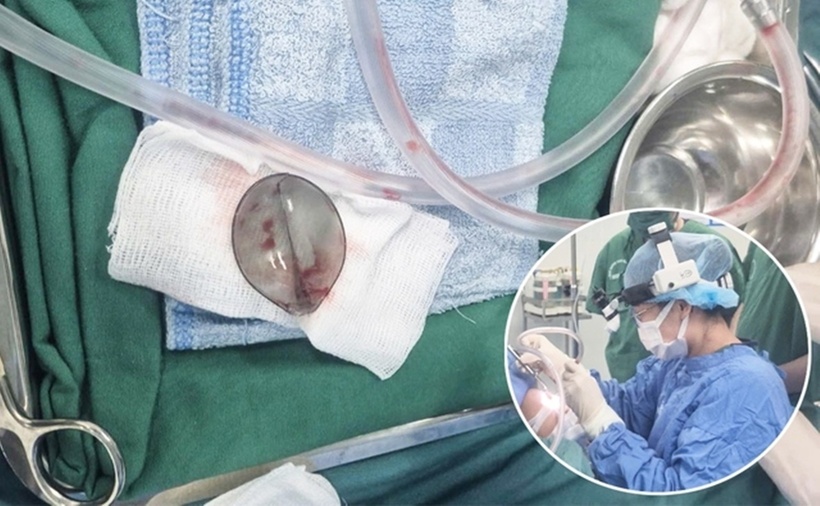 Phần đầu muỗng nhựa bị gãy được các bác sĩ lấy ra khỏi đường thở của bé trai 4 tuổi. (Ảnh: Báo Sức khỏe và Đời sống).