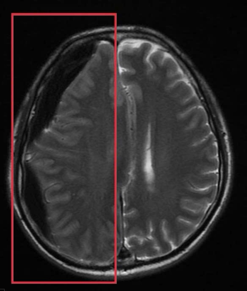 Khối tụ máu não dưới màng cứng mạn tính kích thước lớn vùng thái dương, gây hiệu ứng khối và đè đẩy đường giữa của não