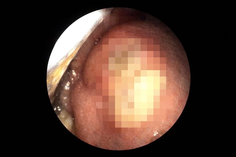 Người đàn ông chủ quan với vết loét tồn tại đã một năm