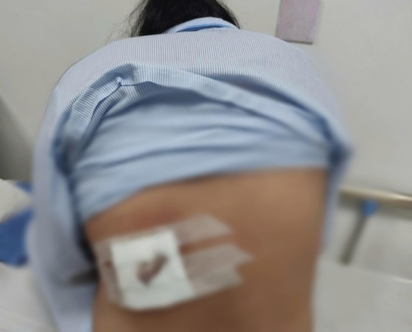 Người phụ nữ bị hoại tử lưng và nhiễm trùng nặng do tự ý bỏ kháng sinh, đắp lá điều trị mụn nhọt. Ảnh: VTC News.