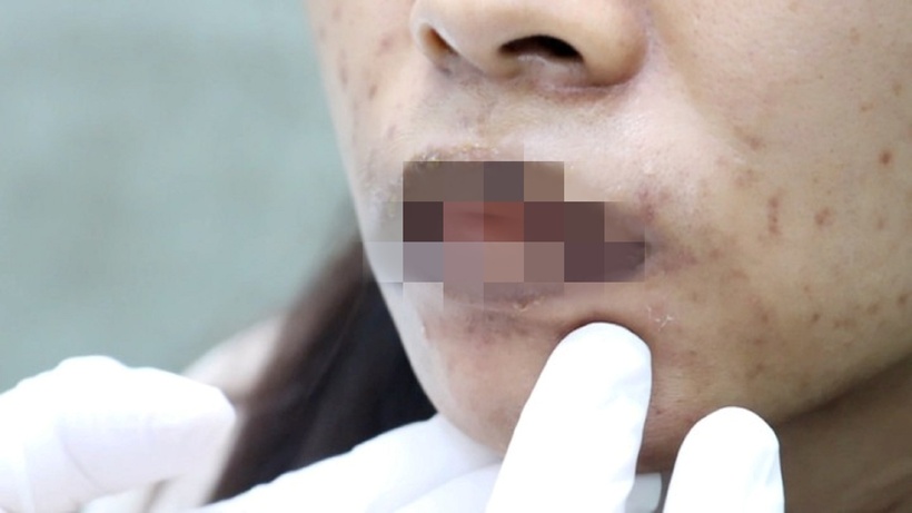 Nữ bệnh nhân biến chứng sau khi&nbsp; khử thâm môi. Ảnh: VTC News.