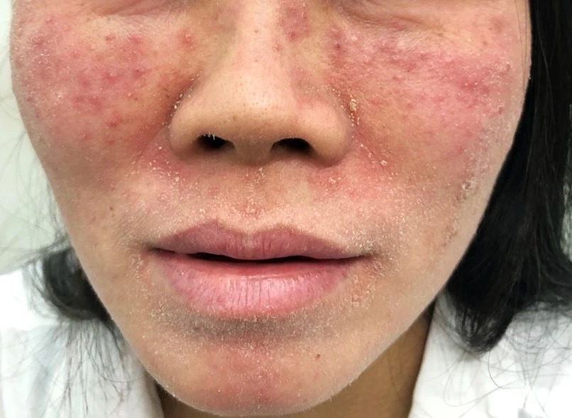 Nhiều người "tiền mất tật mang" sau khi làm đẹp cấp tốc. Ảnh: PLO.