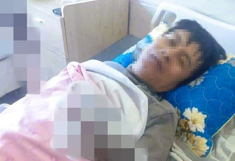 Bệnh nhân bỏng nặng hai tay. Ảnh: Người Lao Động.