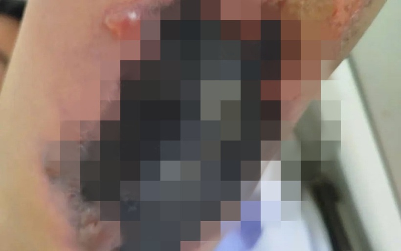 Bệnh nhân bị hoại tử da khô. Ảnh: VTV.