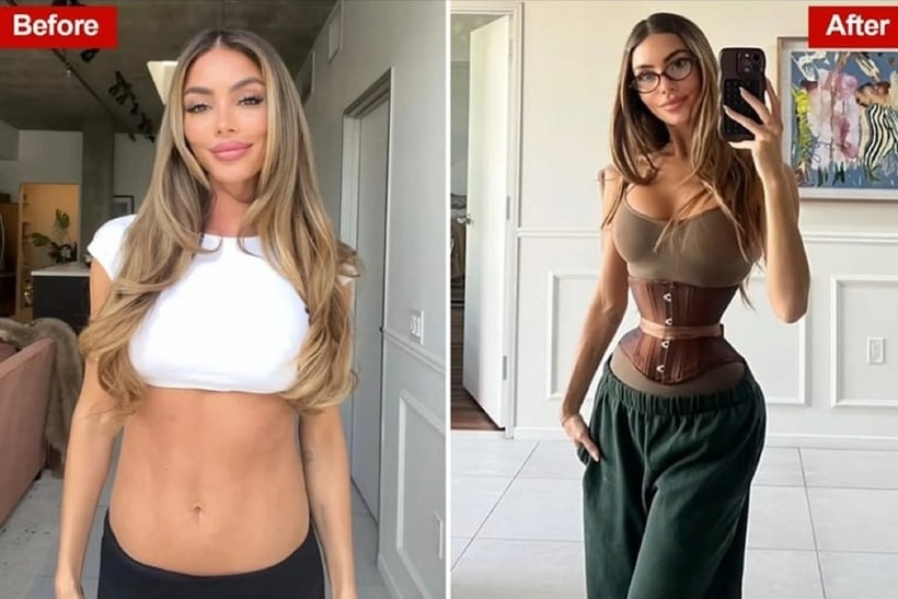 Enna Schell một trong những cô gái thực hiện phẫu thuật cắt xương sườn để sở hữu vòng eo "con kiến". Ảnh: NYPost.