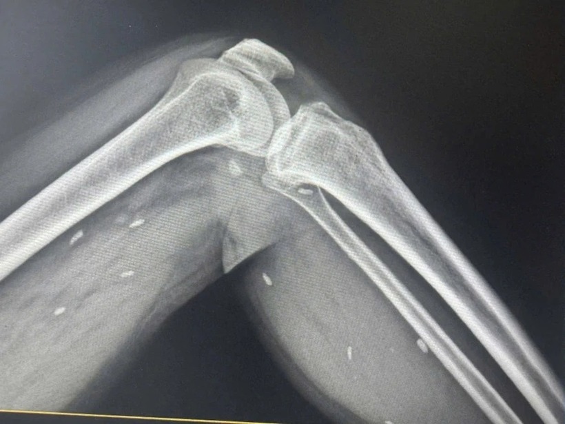 Nhiều kén sán kích thước như hạt gạo nằm rải rác ở các mô vùng xương đùi và cẳng chân bệnh nhân. Ảnh: PLO.