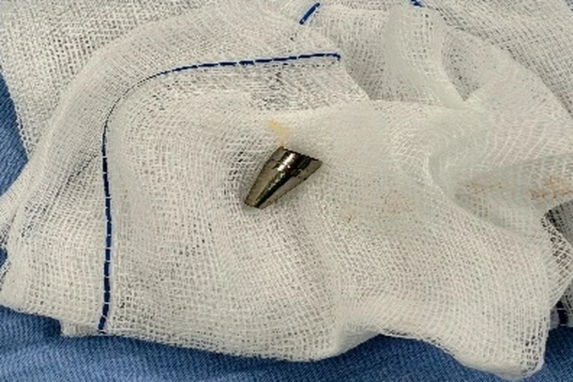 Đầu ngòi bút nhựa được lấy ra từ đường thở của bệnh nhi. Ảnh: Báo Dân trí.