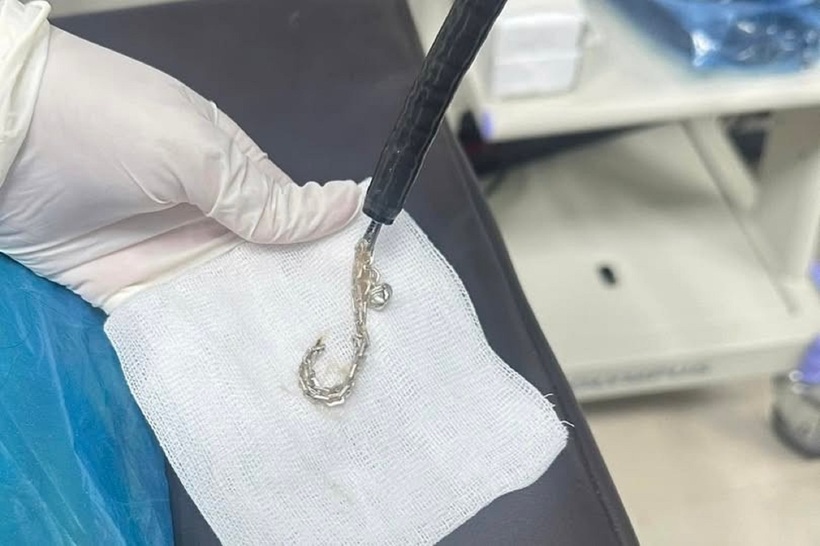 Chiếc lắc bạc được lấy ra từ dạ dày bệnh nhi. Ảnh: Tri Thức & Cuộc sống.