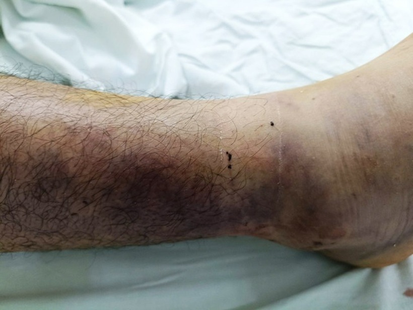 Vết rắn lục xanh đuôi đỏ cắn tại vùng mắt cá chân bệnh nhân. Ảnh: Sức khỏe & Đời sống