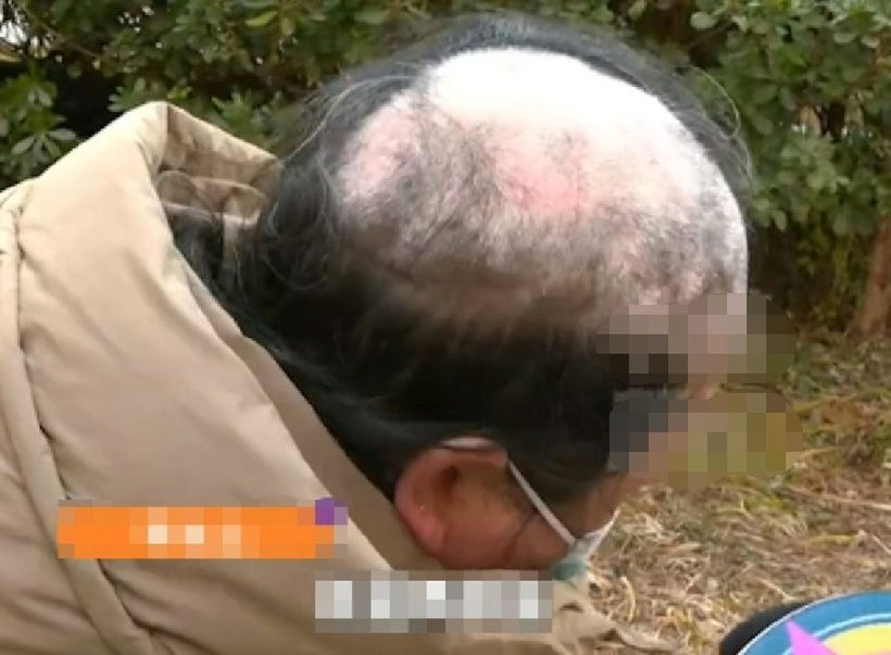 Người phụ nữ mắc bệnh bạch biến khiến tóc rụng, ngoại hình già nua. Ảnh: Baidu.