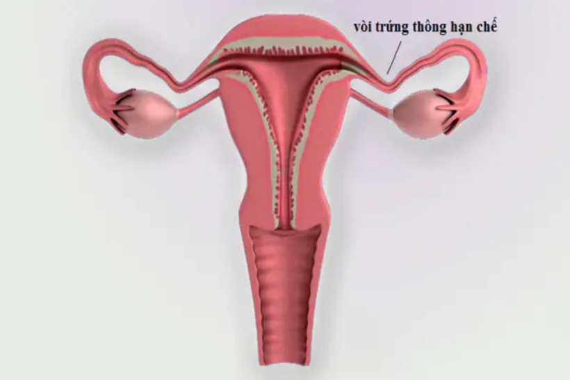 Vòi trứng thông hạn chế chủ yếu do thói quen vệ sinh và lối sống gây ra. Một số ít trường hợp mắc bệnh là do bẩm sinh, tức là vòi trứng gặp phải bất thường từ khi sinh ra.