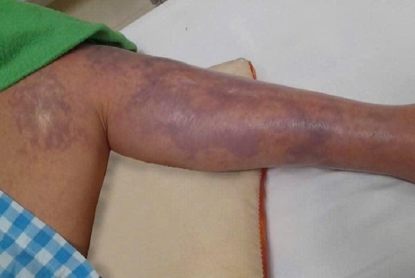 Bị vây cá đâm vào tay, người đàn ông suýt mất mạng vì nhiễm vi khuẩn nguy hiểm. Ảnh: Tạp chí Tri thức.
