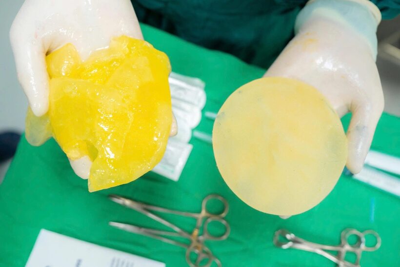 Nhiều người lo ngại&nbsp;“vỡ túi ngực” khi chơi pickleball