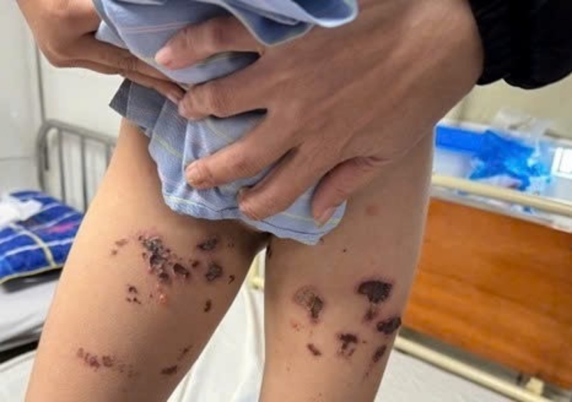 Bé trai bị bỏng nặng ở phần đùi. Ảnh: Tri Thức & Cuộc sống.