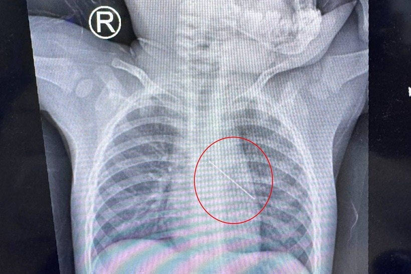 Ảnh chụp X-quang cho thấy kim đâm vào phế quản bé. Ảnh: Dân Trí.
