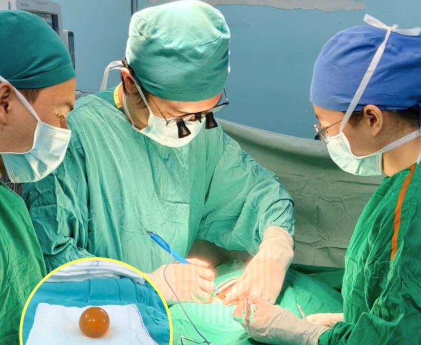 Hạt nở được ê-kíp phẫu thuật mở ruột lấy ra. Ảnh: SK & ĐS.