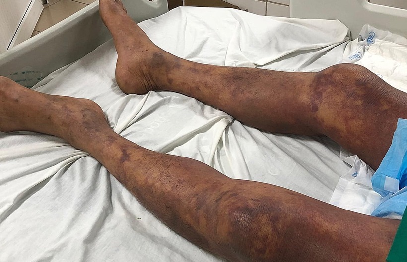 Nhập viện cấp cứu vì quan niệm ăn tiết canh đầu tháng để "lấy may". Ảnh: Vietnamnet.