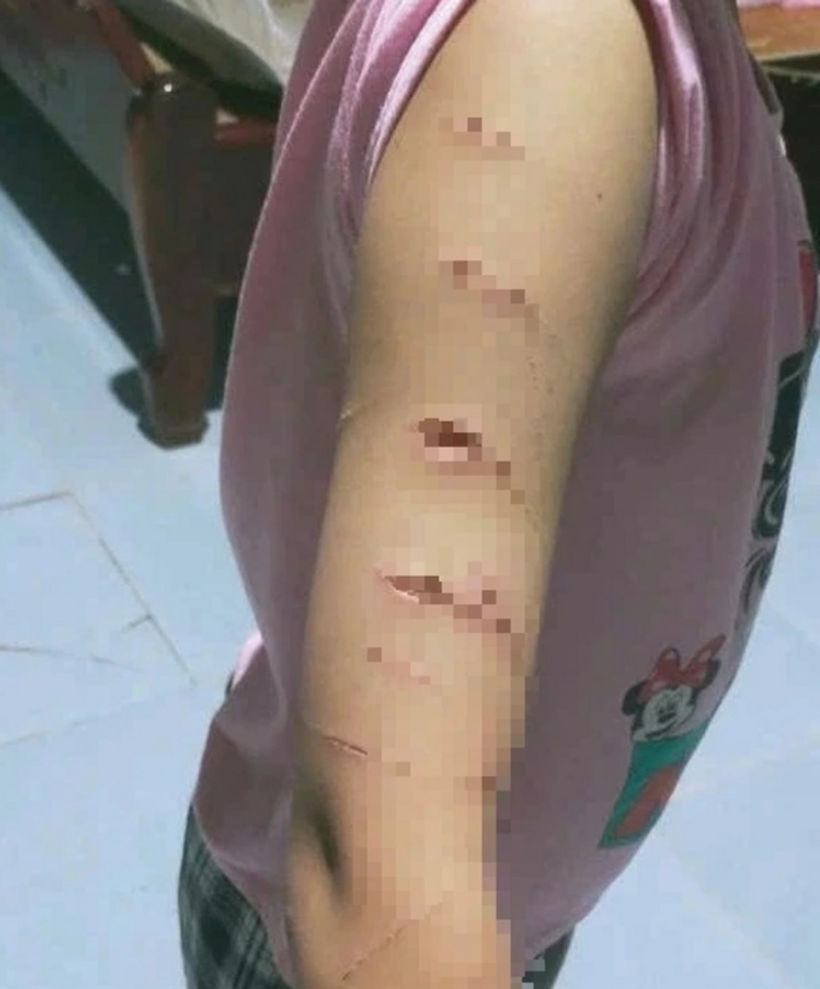 Xuất phát từ mâu thuẫn trong sinh hoạt hàng ngày, khi hai chị em ở chung nhà, nữ sinh lớp 5 ở Cà Mau đã bị chị họ dùng dao rọc giấy rạch nhiều nhát lên tay. Ảnh: Tiền Phong.