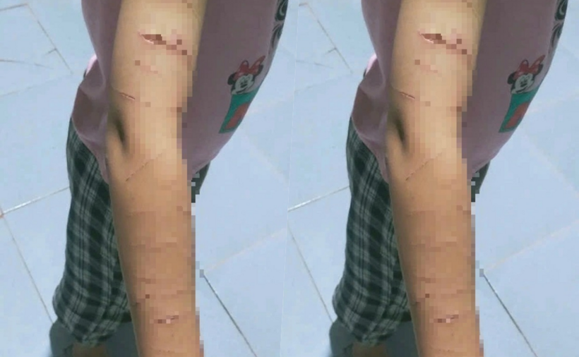 Vết thương chi chít trên cánh tay của em T.T.N, học sinh lớp 5, nghi do chị họ dùng dao cắt giấy gây ra. (Ảnh: Thanh niên)