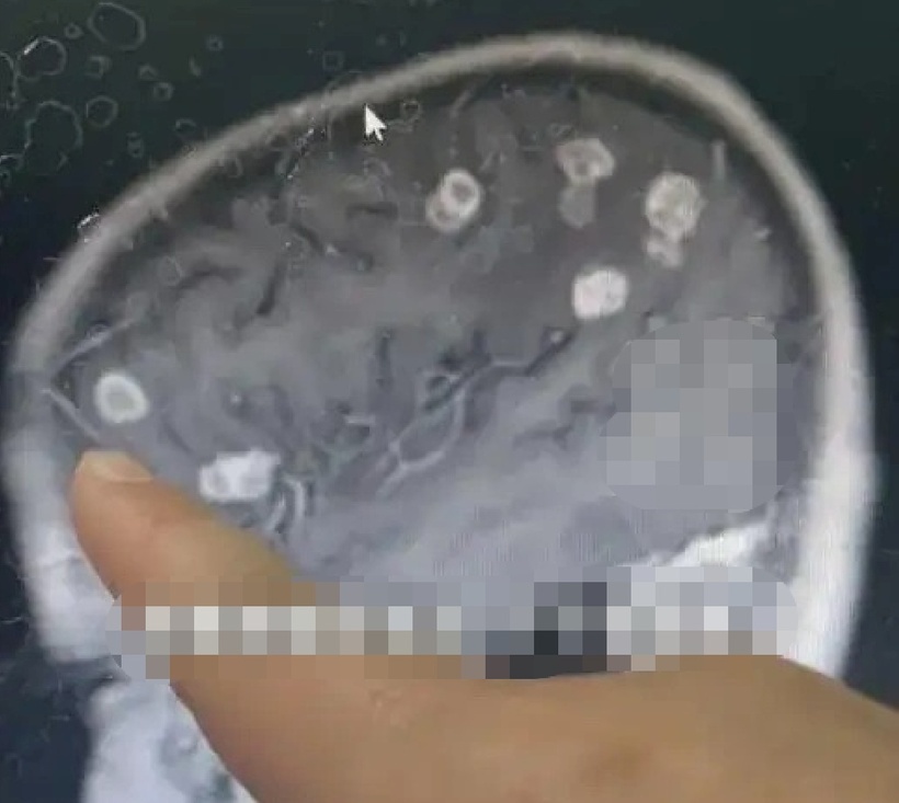 Hít phải nấm mốc khi dọn nhà đón Tết, bé gái 6 tuổi nhập viện cấp cứu. Ảnh: Qianjiang Evening News.