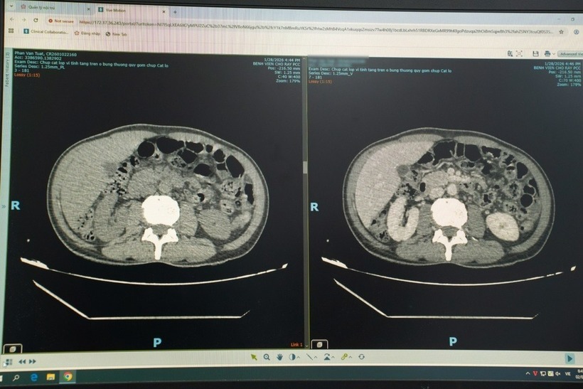 Hình ảnh CT Scan ổ bụng của nam bệnh nhân. Ảnh: Tạp chí Tri Thức.