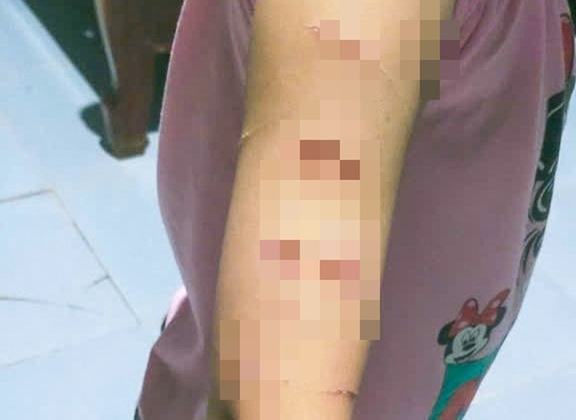 Bé gái lớp 5 nghi bị chị họ bạo hành gây thương tích ở Cà Mau. Ảnh: Báo Tuổi trẻ.