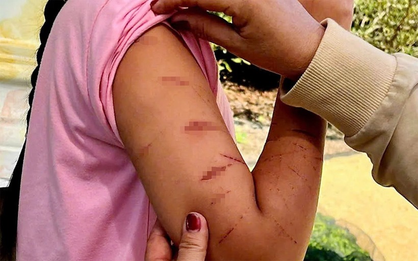 Một số vết thương trên cơ thể em N. Ảnh: Vietnamnet.