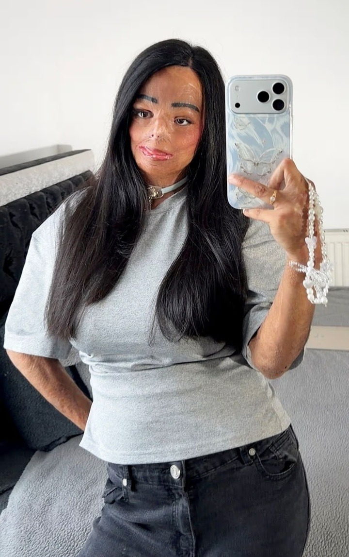 Aleema sau tai nạn. Ảnh: Mirror.