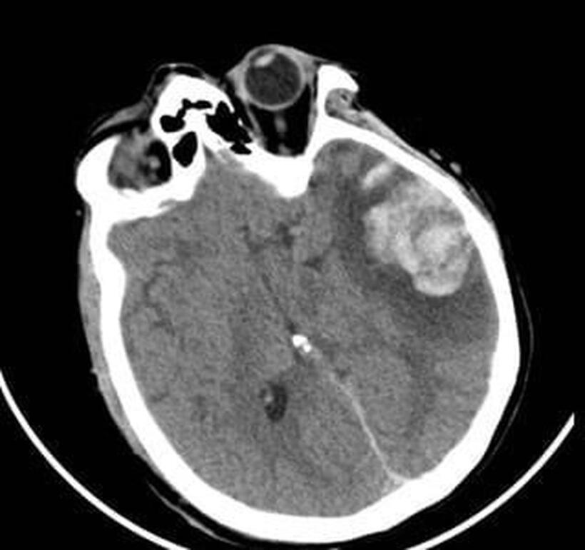Phim CT scan ngày 06/01/2026 người bệnh G.N. cho thấy vùng dập não xuất huyết thái dương lớn kèm phù tổ chức xung quanh. Ảnh: Bệnh viện Nhân dân 115.