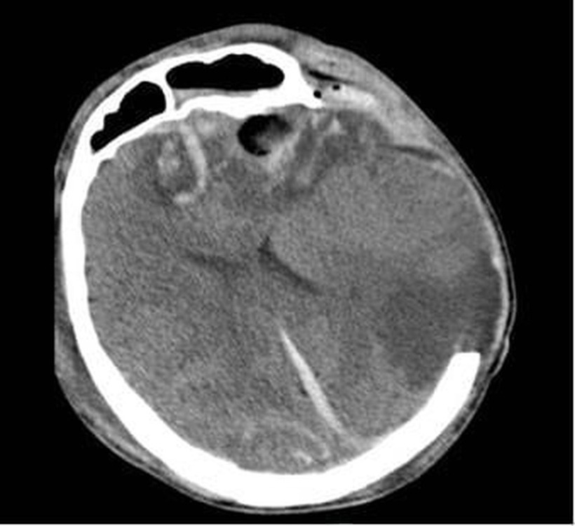 Phim CT não người bệnh G.A. ngày 06/01/2026 cho thấy dập não xuất huyết nhiều nơi, phù não lan tòa dù đã được mở sọ giải ép tối đa. Ảnh: Bệnh viện Nhân dân 115.