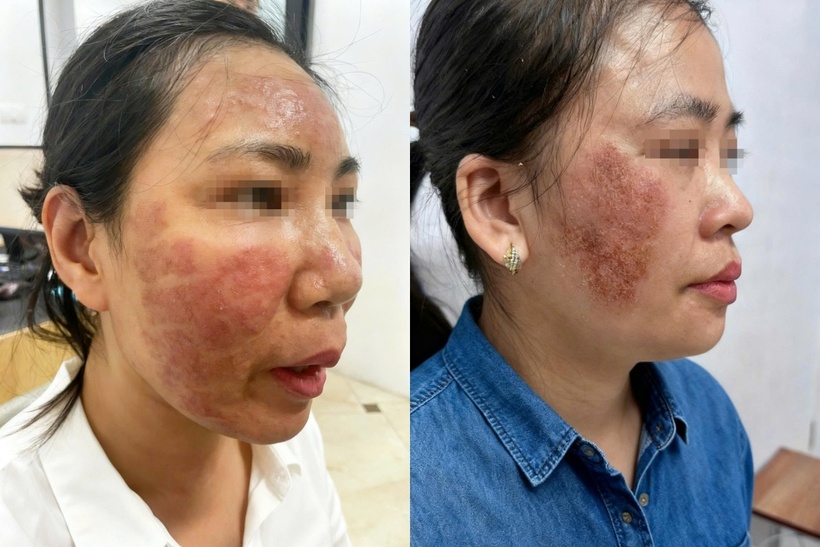 Nhiều trường hợp gặp biến chứng từ việc làm đẹp cận Tết. Ảnh minh họa