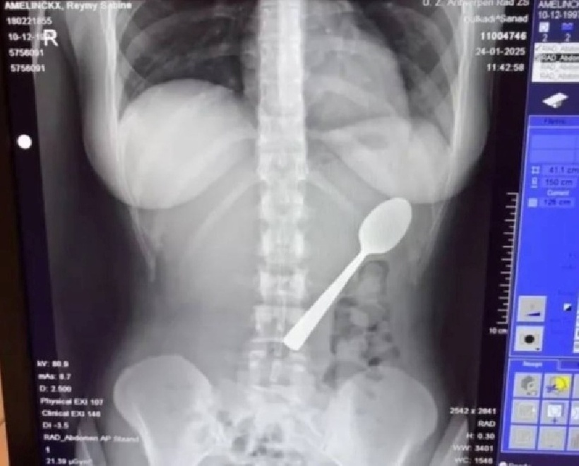 Cô gái 28 tuổi phải nuốt luôn chiếc thìa dài 17cm. Ảnh: Jam Press.