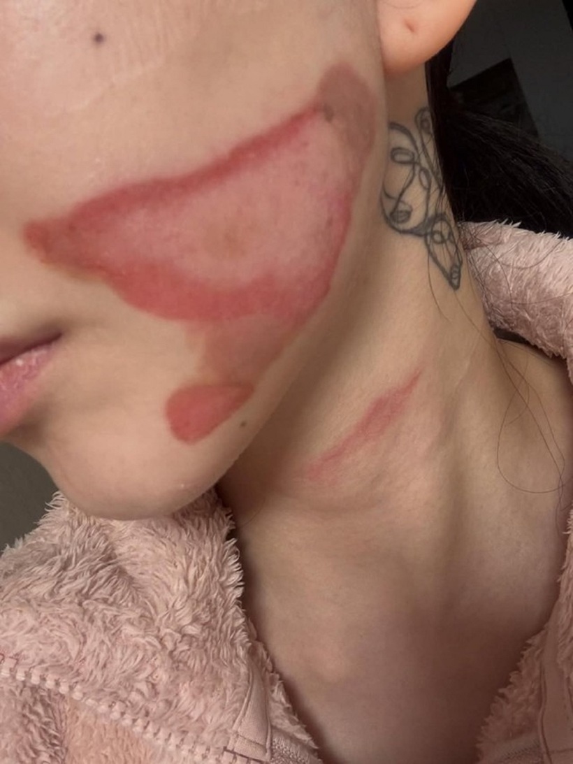  Nữ ca sĩ kiêm diễn viên nổi tiếng "sốc nặng" vì bị bỏng nghiêm trọng sau thẩm mỹ - 1