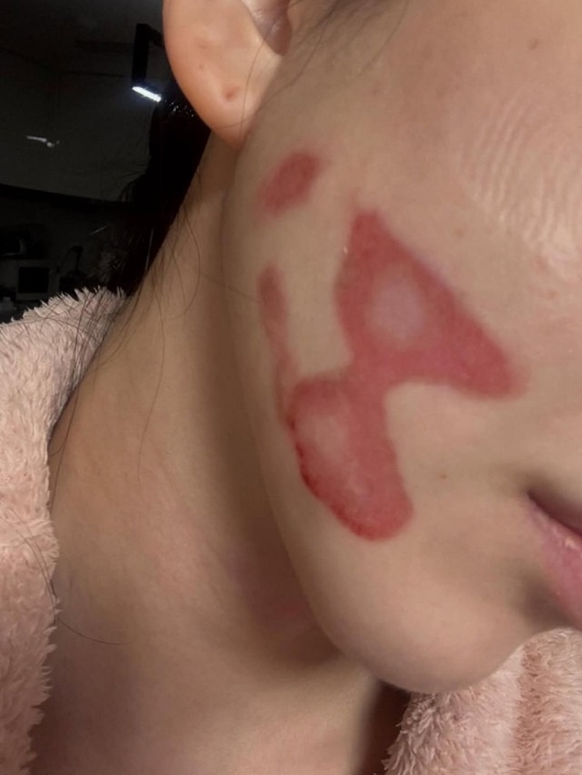 Mina bị bỏng mặt nghiêm trọng sau khi tới 1 cơ sở y tế thực hiện nâng cơ mặt bằng laser. Ảnh: Naver