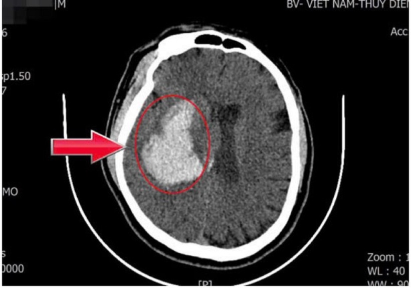 Hình chụp phim não của nam bệnh nhân. Ảnh: VietNamNet.