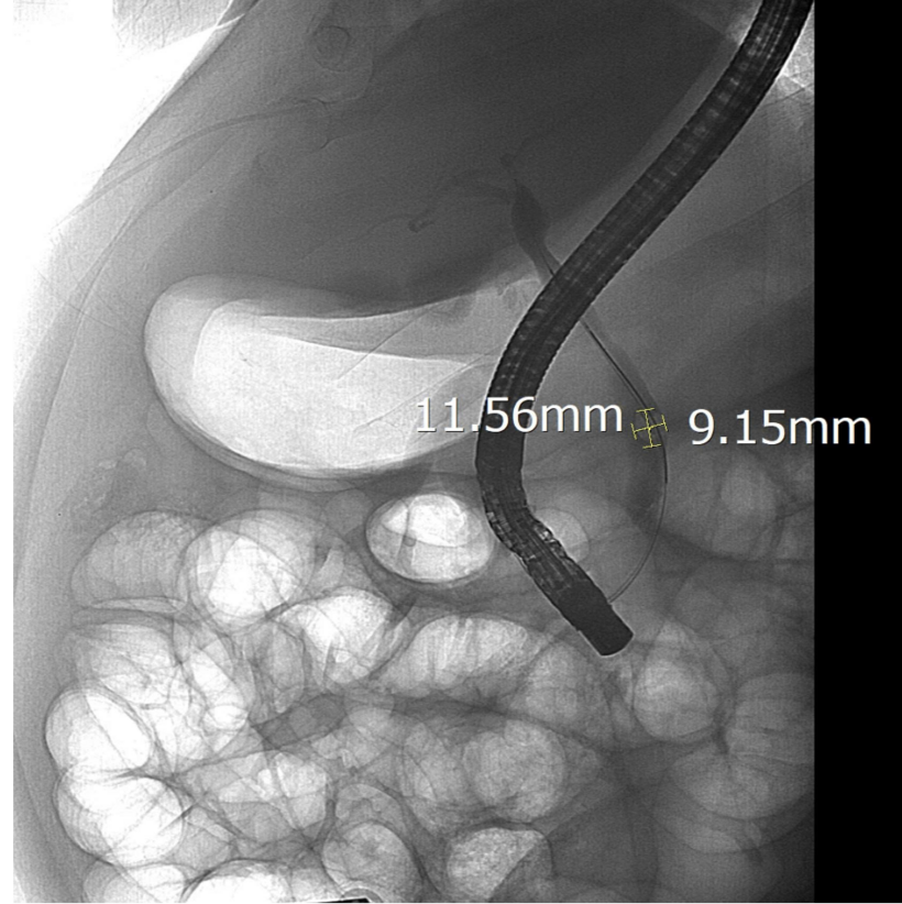 Sỏi ống mật chủ được lộ rõ dưới chụp DSA