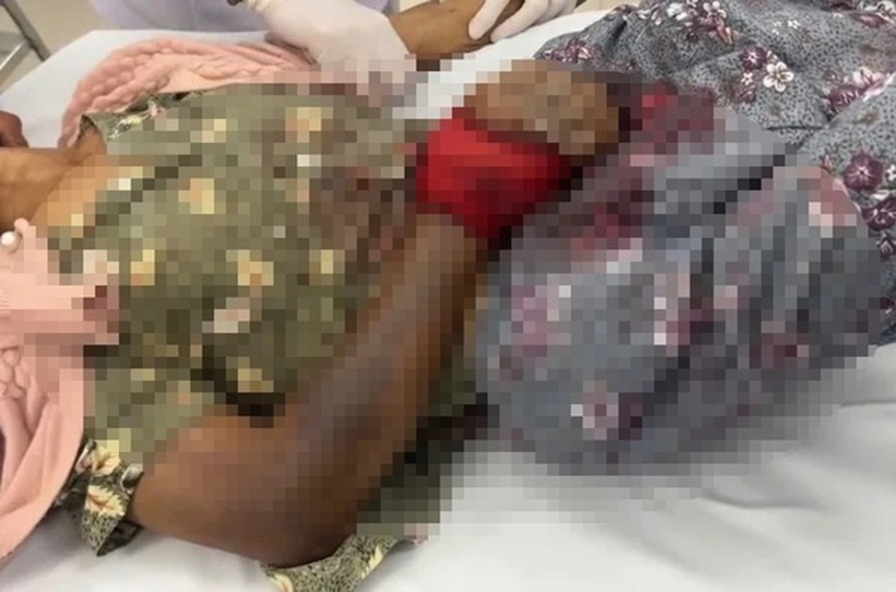 Tay nạn nhân bị rắn độc cắn sưng to, tím đen và có dấu hiệu hoại tử. Ảnh: Sức khỏe & Đời sống