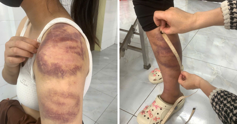 Những vết bầm tím trên cơ thể cháu T. do bị bố đẻ đánh. (Ảnh: Công an Bắc Ninh)