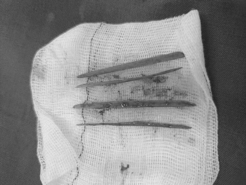 Dị vật sắc nhọn được lấy ra từ đường tiêu hóa. Ảnh: Đại biểu Nhân dân.