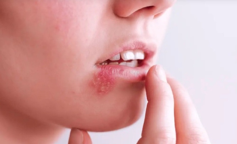 Chủ quan với nốt mụn rộp ở miệng, người phụ nữ 30 tuổi rơi vào tình trạng chết não. Ảnh minh họa.