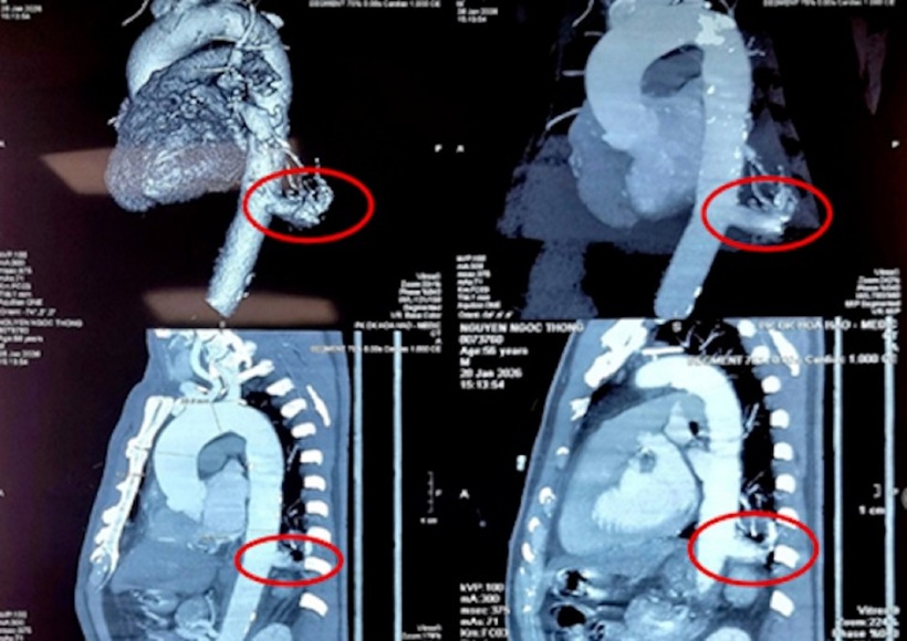 Ảnh chụp phim &nbsp;phần phổi dư thừa của bệnh nhân. Ảnh: Vnexpress.