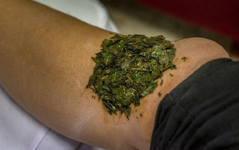 Nguy cơ tiềm ẩn khi đắp lá lên vùng tổn thương. Ảnh minh họa.