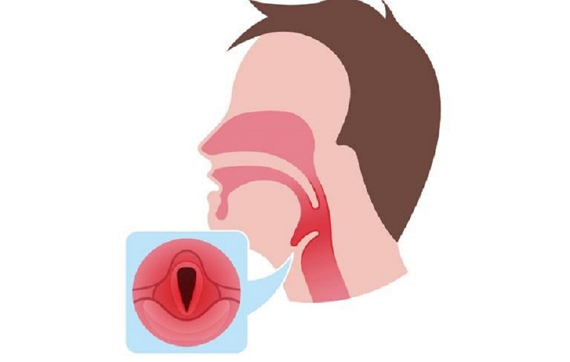 Viêm thanh quản gây khàn tiếng, mất giọng