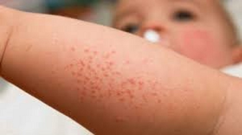 Rôm sảy khiến bé ngứa ngáy, khó chịu