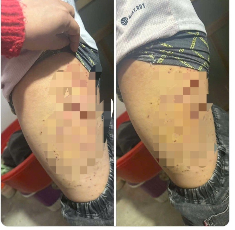 Hình ảnh em học sinh với nhiều vết chấm đỏ trên phần đùi. Ảnh: VietNamnet