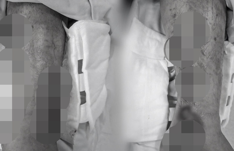 Chân bệnh nhân bị nổi bóng nước. Ảnh: Tạp chí Tri Thức.